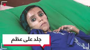 عجوز في عز طفولتها ...هذا ما يحدث لأطفال اليمن بسبب الجوع