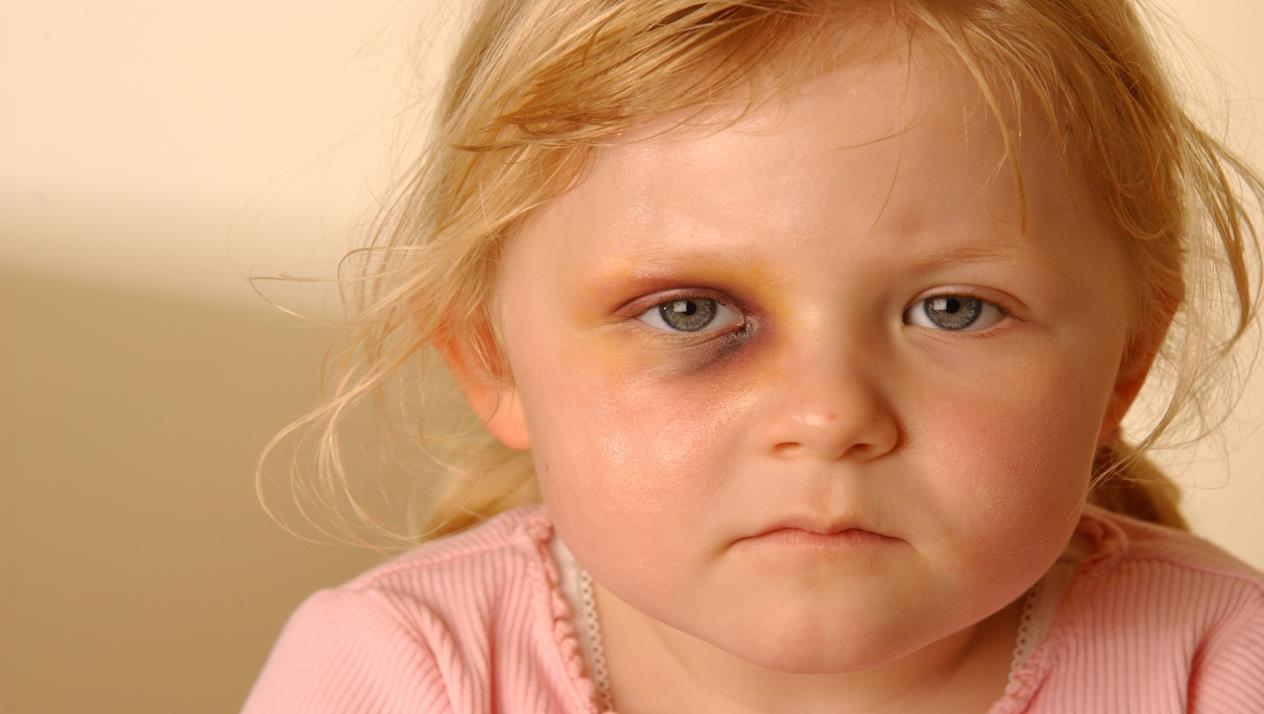 حوادث العيون عند الأطفال ..كيف تتصرف ؟