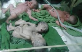 عملية ولادة ل4 توأم 2 منهم سيامي في أحد مستشفيات صنعاء
