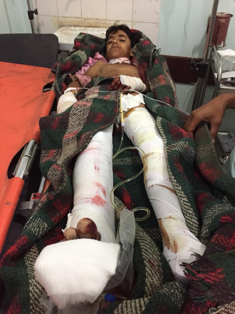 إصابة وإعاقة طفل بقصف للمليشيات الحوثية في قرية الخوره  