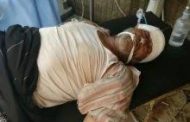 قناص حوثي يصيب موظف بشركة الحاسدين برصاص برأسه