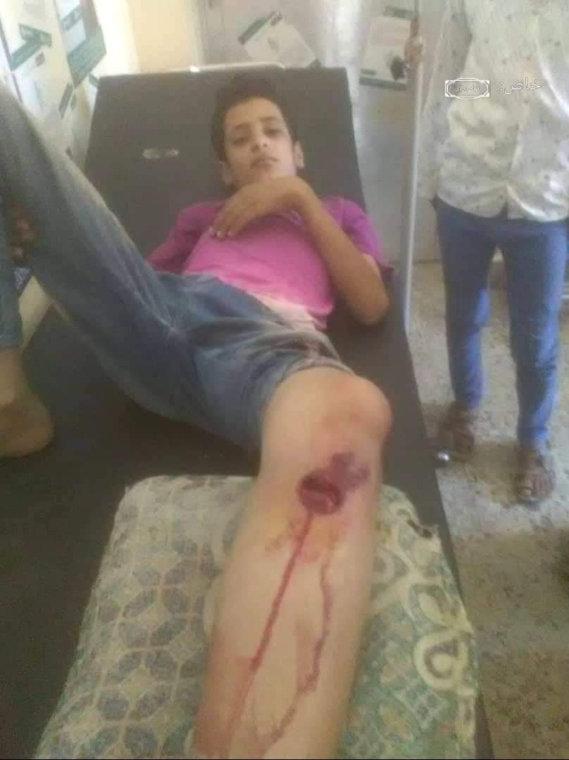 إصابة مدنيين بينهم أطفال في حادثين منفصلين شمال غرب الضالع