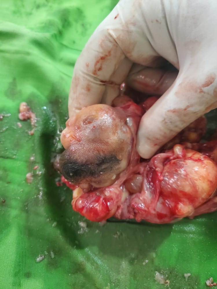 نجاح عملية نادرة وغير مسبوقة لطفلة توأمها داخلها في أحد مشافي حضرموت