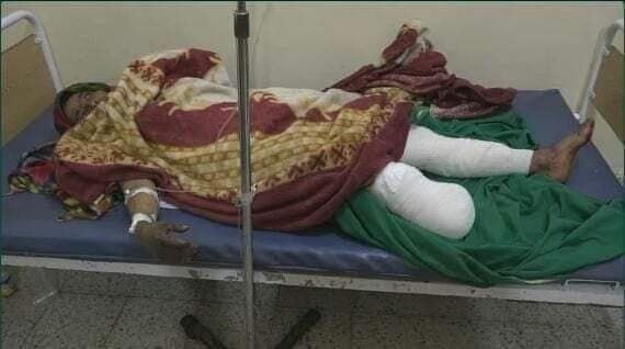 إصابة امرأة في تعز بجروح خطيرة وبتر ساقها ..بسبب انفجار في جبل حبشي 