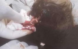 رصاص راجع يصيب طفلة في منطقة رصد بيافع