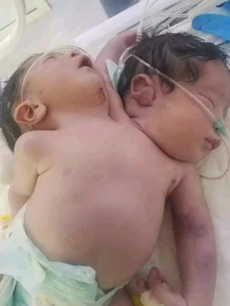 ولادة نادرة في صنعاء.. طفل برأسين