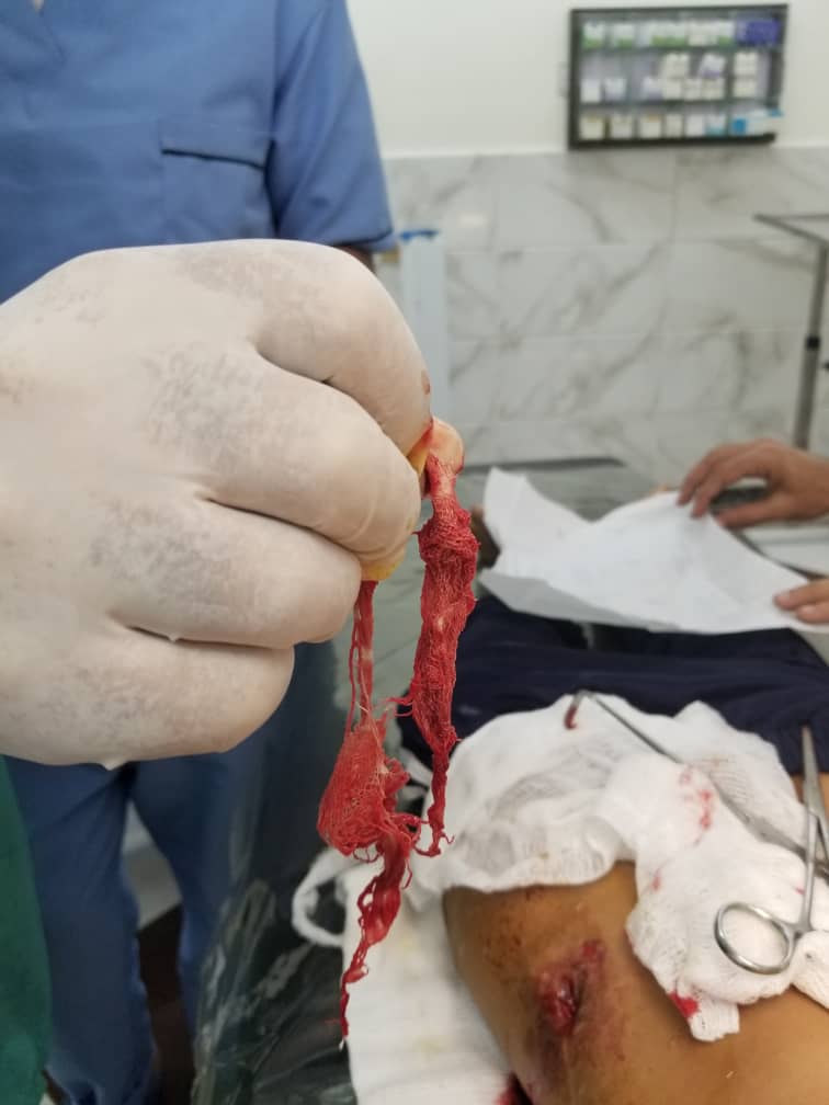 فريق طبي في مستشفى البسام ينجح في استخراج قطعة شاش منسية داخل بطن طفل 