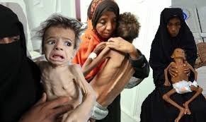 الصحة العالمية : اليمن وصلت الى أعلى معدلات الهزال والتقزم في العالم