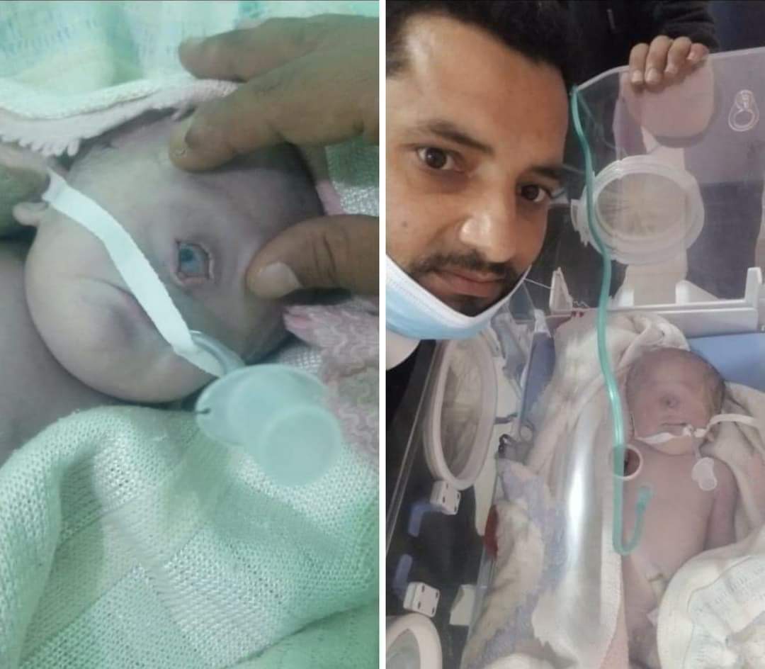 ولادة طفل يمني بعين واحدة بالبيضاء 