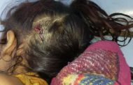 إصابة طفلة بطلق ناري بالرأس ومدير مخيمات النازحين في أبين يناشد الجهات الأمنية 