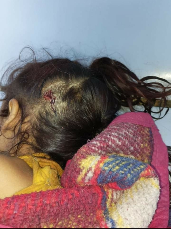 إصابة طفلة بطلق ناري بالرأس ومدير مخيمات النازحين في أبين يناشد الجهات الأمنية 