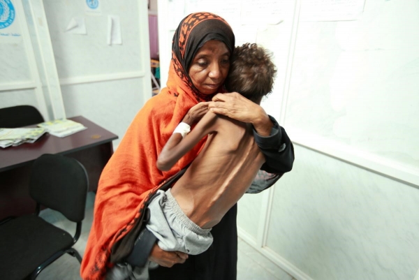 أرتغاع معدلات تقزم الأطفال .. المفوضية الأوروبية تحذّر من ارتفاع سوء التغذية الحاد في اليمن