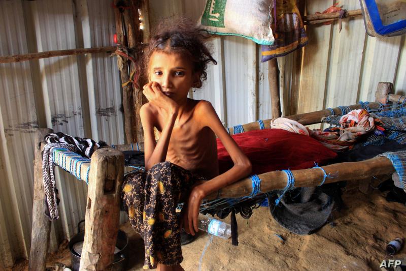 لمكافحة سوء التغذية في اليمن .. اليونسيف تتلقى 3 مليون دولار