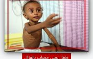 الصحة العالمية مليوني طفل يمني يعانون من الهُزال