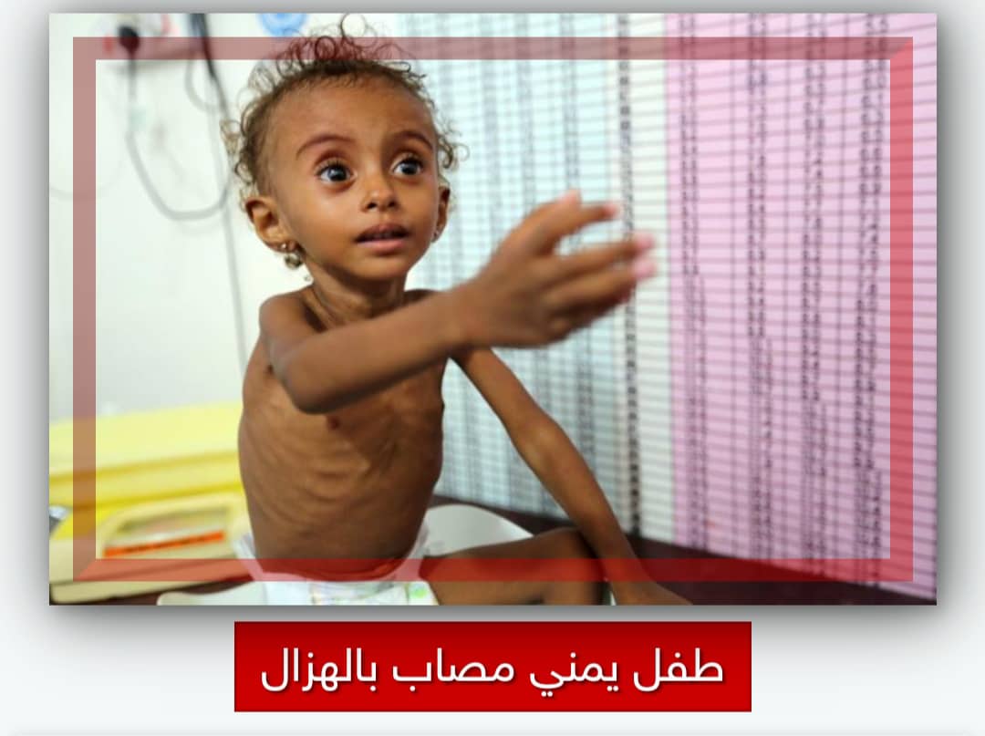 الصحة العالمية مليوني طفل يمني يعانون من الهُزال
