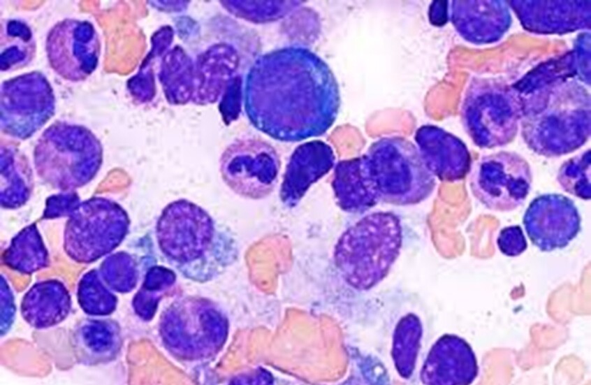 اكتشاف أول حالة نادرة لمرض 