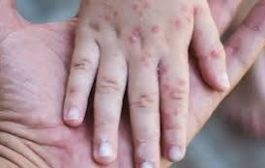 أمريكا تسجل أكثر من 800 إصابة بالحصبة منذ بداية العام
